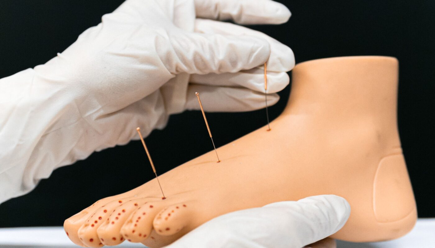 Wat je moet weten over een dry needling behandeling voor je spieren