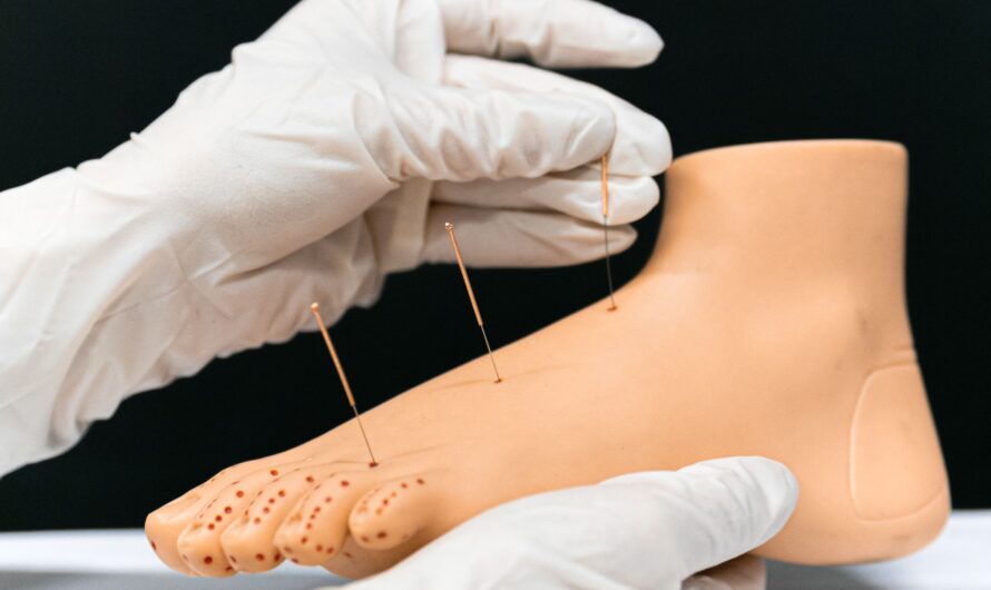 Wat je moet weten over een dry needling behandeling voor je spieren